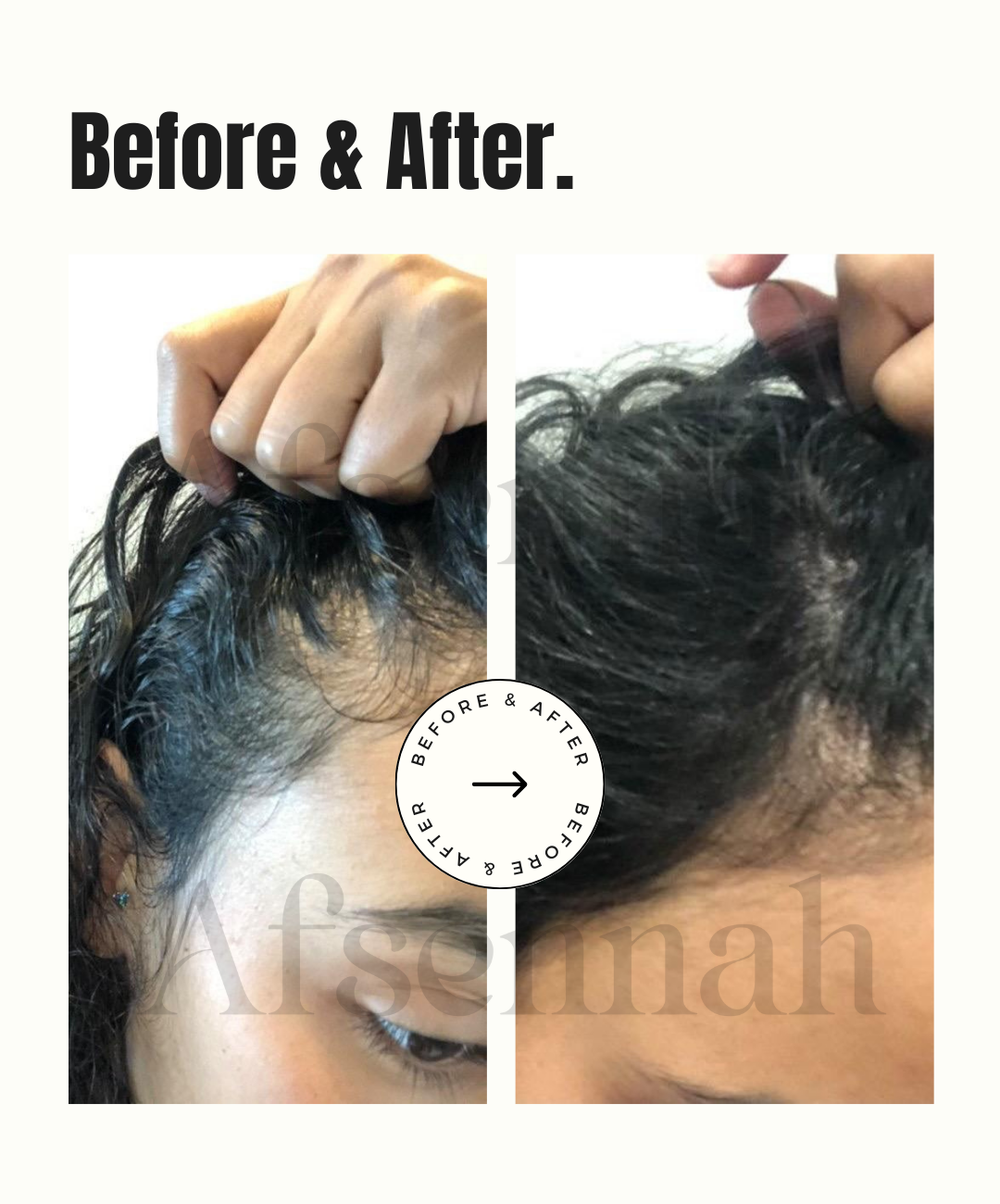 Individuelle Haarwuchs-Kopfhautbehandlung